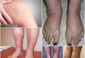 Fotos de venas varicosas en las piernas