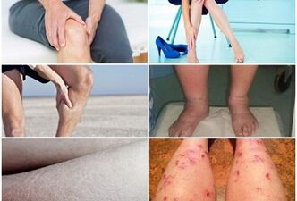 Síntomas de las venas varicosas en las piernas