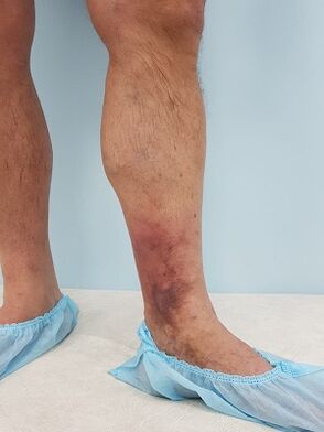 Complicaciones de las venas varicosas en los hombres.