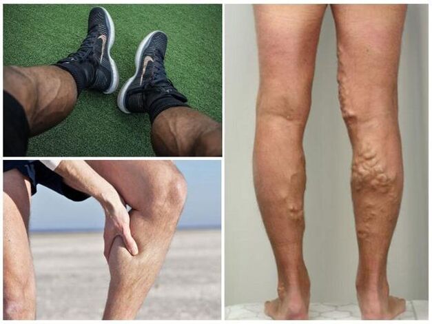 ¿Cómo son las venas varicosas en las piernas de un hombre