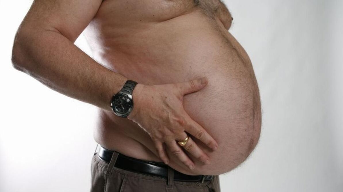 La obesidad es una causa del desarrollo de venas varicosas. 