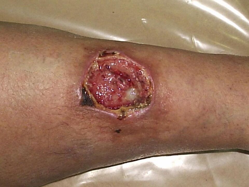 Úlcera trófica de varices tardías