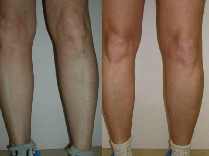 Tratamiento con láser de piernas antes y después de las varices. 
