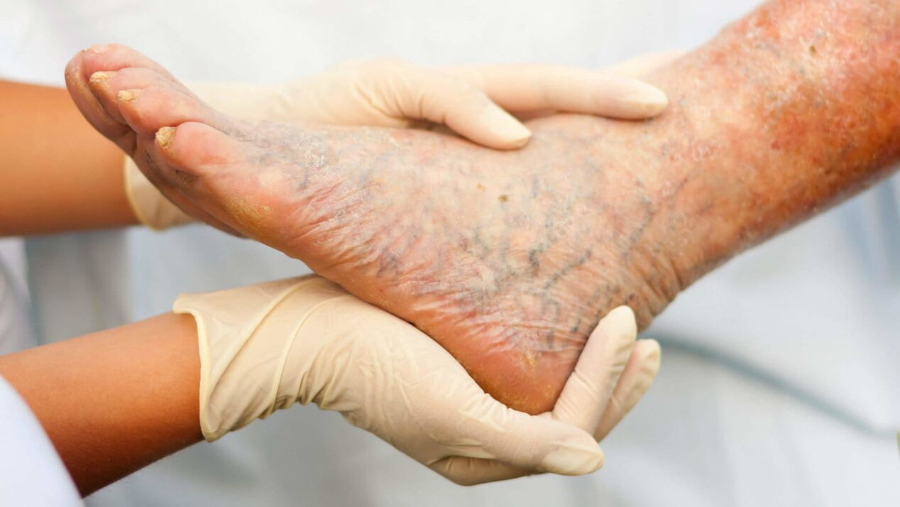 Un flebólogo maneja el tratamiento de las varices en las piernas