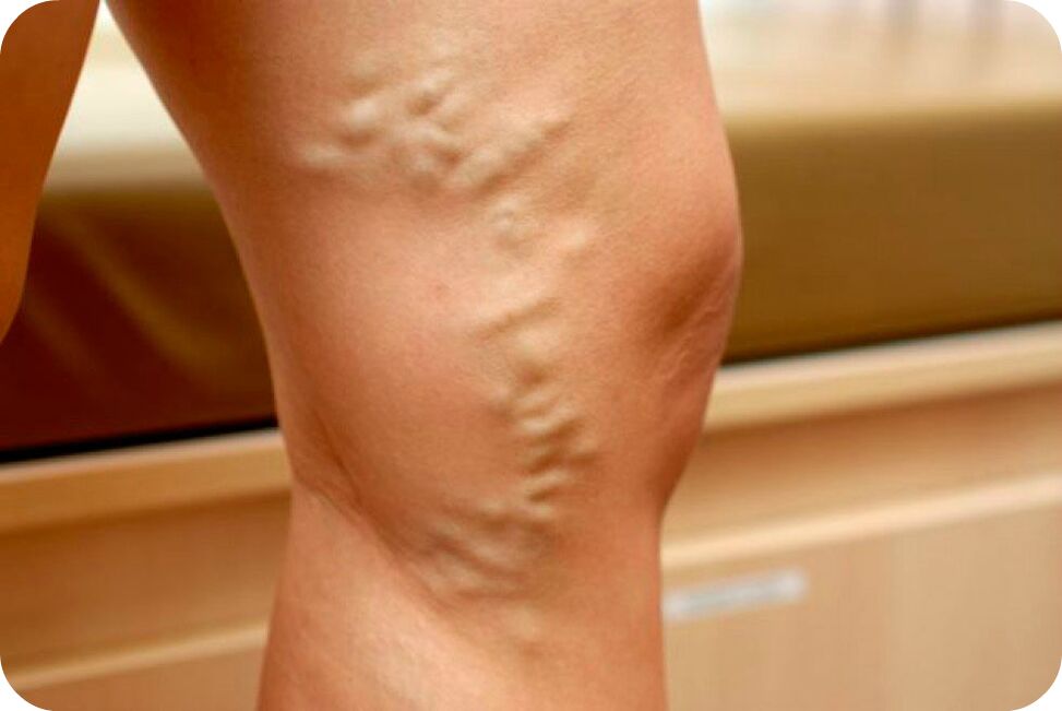 Venas varicocele en la línea