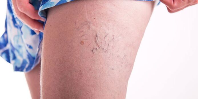 Prevenir las venas varicosas