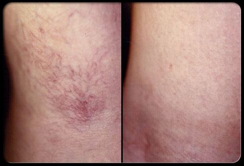 Antes y después de la terapia de esclerosis