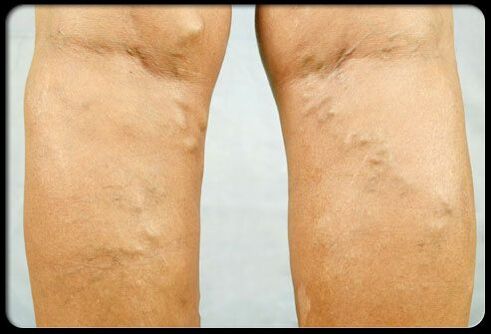 Venas en las piernas
