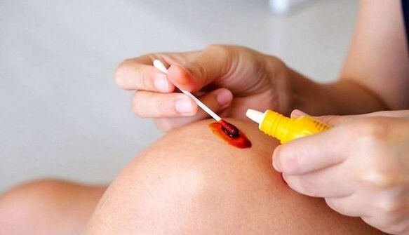 Tratamiento con yodo para las varices.