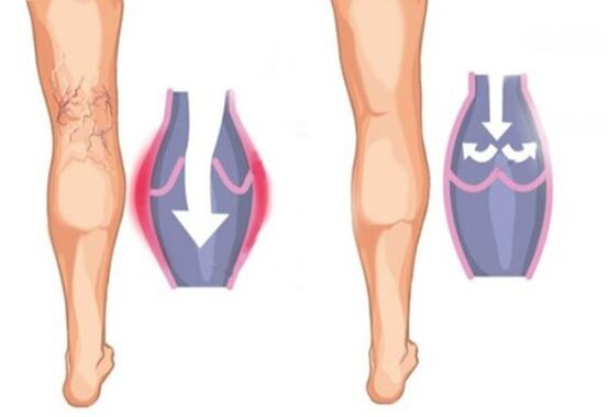 ¿Cómo son las venas varicosas