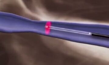 tratamiento térmico